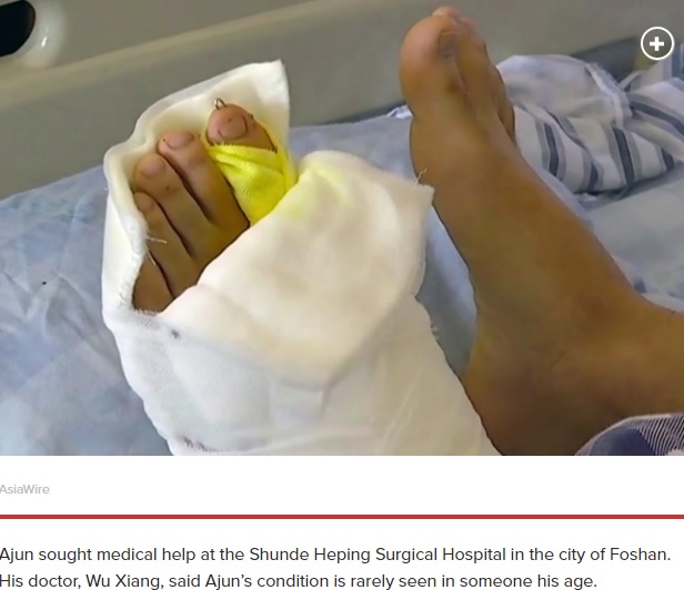 手術を受け5本になった足の指（画像は『New York Post　2019年10月31日付「Man born with 9 toes on left foot gets surgery, hopes for first love」（AsiaWire / Shunde Heping Surgica）』のスクリーンショット）