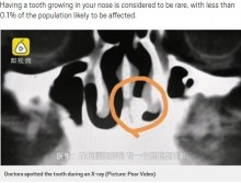 【海外発！Breaking News】鼻の奥で歯が成長した30歳男性　「20年前の怪我が原因」と医師（中国）