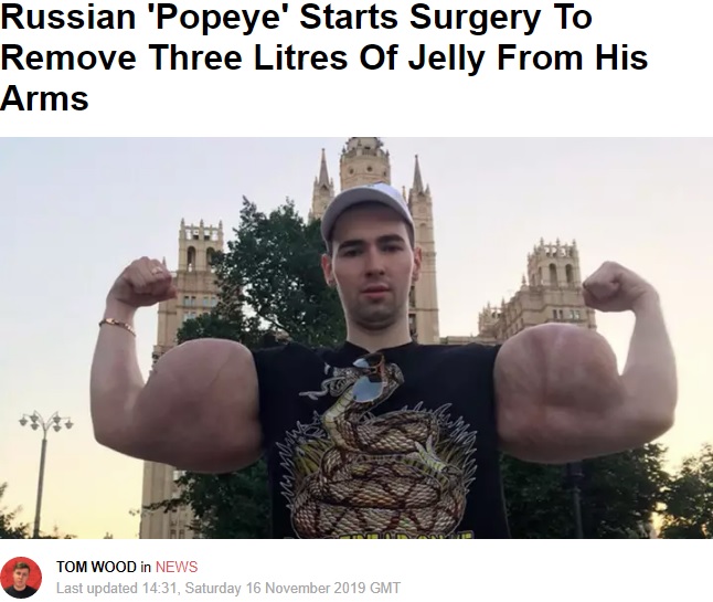 油脂の注射によりたくましい両腕に（画像は『LADbible　2019年11月16日付「Russian ‘Popeye’ Starts Surgery To Remove Three Litres Of Jelly From His Arms」』のスクリーンショット）