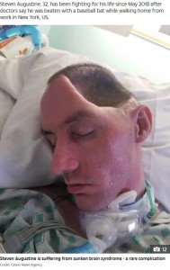 頭が陥没してしまったスティーブンさん（画像は『The Sun　2019年11月8日付「CAVED IN Dad left paralysed with half a skull and ‘sunken’ brain after brutal attack by thug who gets just two months in jail」（Credit: Caters News Agency）』のスクリーンショット）
