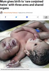 臓器を共有する結合双生児（画像は『Metro　2019年11月26日付「Mum gives birth to ‘rare conjoined twins’ with three arms and shared organs」（Picture: Caters）』のスクリーンショット）