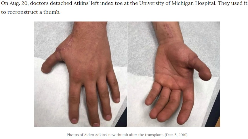 手術から3か月半後のエイデンさんの手（画像は『WKRN.com　2019年12月6日付「Doctors use man’s toe to recreate sawed-off thumb」』のスクリーンショット）