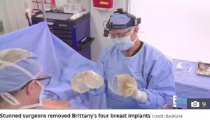 4つのシリコンバッグを取り出した医師（画像は『The Sun　2019年12月11日付「DOUBLED UP Woman with TWO implants stacked in each breast begs Botched docs for help」（Credit: BackGrid）』のスクリーンショット）