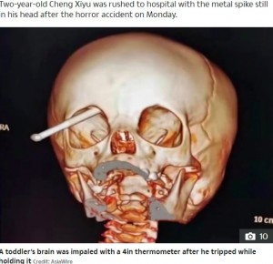 温度計は目から脳へ（画像は『The sun　2019年12月13日付「FREAK ACCIDENT Toddler impales brain on 4ins thermometer after he fell and it pierced his eye socket」（Credit: AsiaWire）』のスクリーンショット）