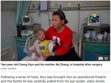 【海外発！Breaking News】転んだ2歳児の頭部に鉄製温度計が突き刺さる（中国）