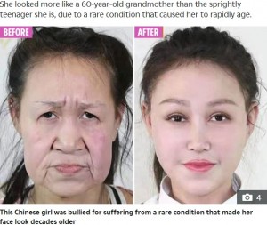 【海外発！Breaking News】早老症で60代に見える15歳少女、手術で新しい顔を手に入れる（中国）＜動画あり＞