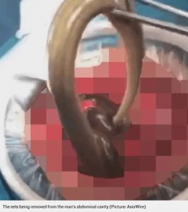 摘出されたウナギ（画像は『Metro　2020年1月16日付「Man almost dies after swallowing two 20-inch eels ‘to cure his constipation’」（Picture: AsiaWire）』のスクリーンショット）