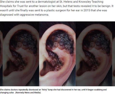 皮膚がんで黒くなったアンシアさんの耳（画像は『Fox News　2020年2月6日付「Mom who lost ear to skin cancer claims tanning as teen led to disease」（Kennedy News and Media)）』のスクリーンショット）