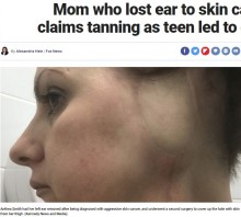 14歳から日焼け用ベッドを使用した43歳女性　皮膚がんで耳を失いさらなる試練が（英）