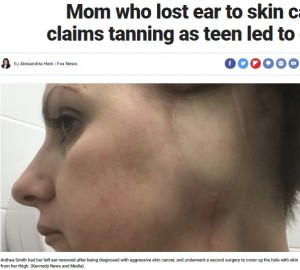 【海外発！Breaking News】14歳から日焼け用ベッドを使用した43歳女性　皮膚がんで耳を失いさらなる試練が（英）