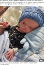 【海外発！Breaking News】脳がほとんどない状態で誕生した水頭症の男児、生後1か月に（英）