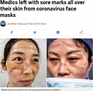 締め付けられたゴーグルの跡（画像は『Metro　2020年2月5日付「Medics left with sore marks all over their skin from coronavirus face masks」（Picture: AsiaWire）』のスクリーンショット）