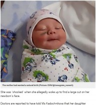 【海外発！Breaking News】帝王切開で女児の顔に傷　医師は「赤ちゃんの動きが激しかったから」（露）