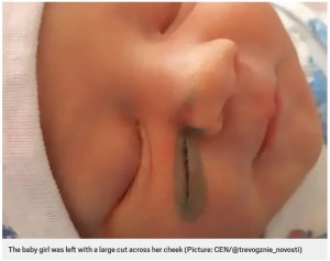 目の下に2センチほどの傷が…（画像は『Metro　2020年1月31日付「Doctor cut baby’s face during c-section because it moved too much」（Picture: CEN/＠trevogznie_novosti）』のスクリーンショット）