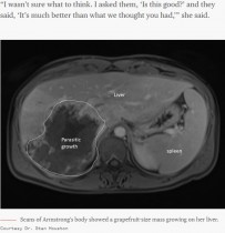【海外発！Breaking News】死を覚悟した肝臓の腫瘍　実は10年超も潜伏した寄生虫だった（カナダ）