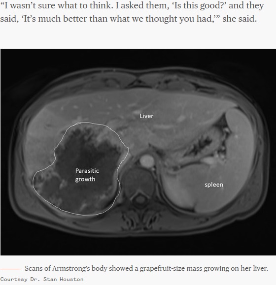 肝臓に映し出された大きな腫瘍（画像は『TODAY　2020年2月14日付「Woman’s grapefruit-size ‘liver cancer’ tumor was actually a parasite」（Courtesy Dr. Stan Houston）』のスクリーンショット）