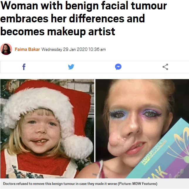 2歳で顔に腫瘍ができ始めた女性（画像は『Metro　2020年1月29日付「Woman with benign facial tumour embraces her differences and becomes makeup artist」（Picture: MDW Features）』のスクリーンショット）