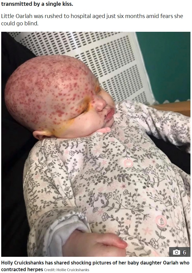 生後6か月でヘルペスに感染したオーラちゃん（画像は『The Sun　2020年3月2日付「‘JUST DEVASTATING’ Mum shares shocking pics of six-month-old baby daughter who contracted herpes」（Credit: Hollie Cruickshanks）』のスクリーンショット）