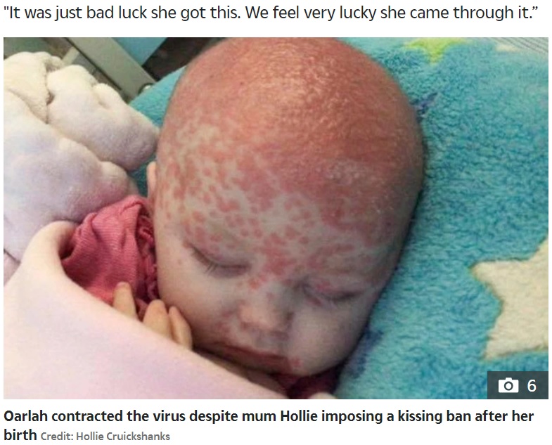 頭が痛々しいオーラちゃん（画像は『The Sun　2020年3月2日付「‘JUST DEVASTATING’ Mum shares shocking pics of six-month-old baby daughter who contracted herpes」（Credit: Hollie Cruickshanks）』のスクリーンショット）