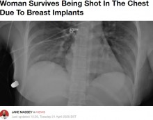 【海外発！Breaking News】豊胸シリコンで命拾い　左胸を撃たれた女性（カナダ）