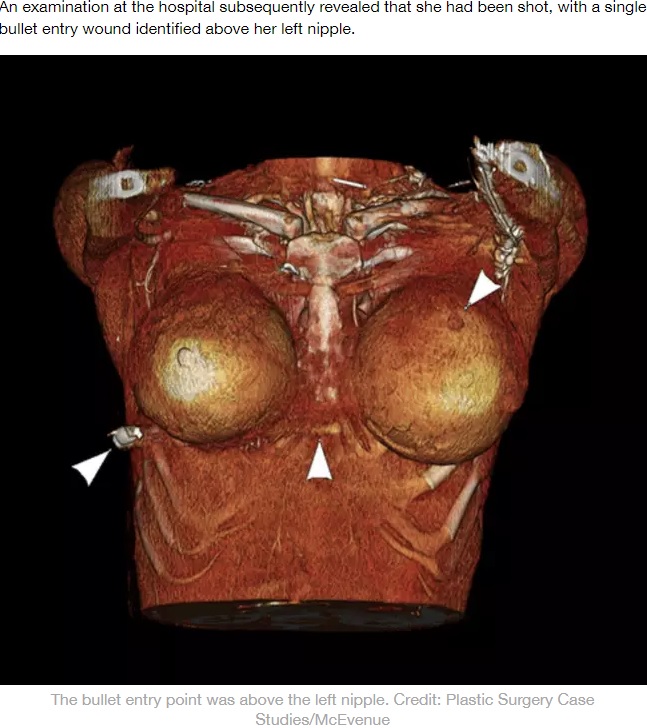 左胸から右胸を貫通した銃弾（画像は『LADbible　2020年4月21日付「Woman Survives Being Shot In The Chest Due To Breast Implants」（Credit: Plastic Surgery Case Studies/McEvenue）』のスクリーンショット）