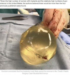 銃弾が貫通したシリコンバッグ（画像は『LADbible　2020年4月21日付「Woman Survives Being Shot In The Chest Due To Breast Implants」（Credit: Plastic Surgery Case Studies/McEvenue）』のスクリーンショット）