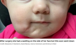 【海外発！Breaking News】120年で症例35件　2つの口を持つ赤ちゃん、切除手術が成功（米）