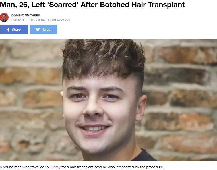 21歳の頃から前髪の生え際が後退し始めたという男性（画像は『LADbible　2020年6月16日付「Man, 26, Left ‘Scarred’ After Botched Hair Transplant」（Credit: SWNS）』のスクリーンショット）