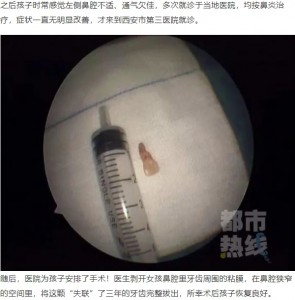 発見された2センチほどの歯（画像は『澎湃新闻　2020年6月26日付「6岁女童鼻子里“长牙”，取出后发现竟是三年前失踪的...」』のスクリーンショット）