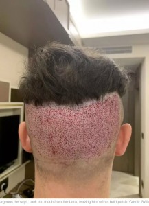 手術の翌日に撮影されたルークさんの後頭部（画像は『LADbible　2020年6月16日付「Man, 26, Left ‘Scarred’ After Botched Hair Transplant」（Credit: SWNS）』のスクリーンショット）