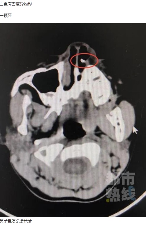 CTスキャンで発見された鼻腔内の歯（画像は『澎湃新闻　2020年6月26日付「6岁女童鼻子里“长牙”，取出后发现竟是三年前失踪的...」』のスクリーンショット）