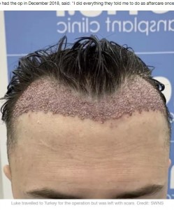 手術後の痕が痛々しいルークさん（画像は『LADbible　2020年6月16日付「Man, 26, Left ‘Scarred’ After Botched Hair Transplant」（Credit: SWNS）』のスクリーンショット）