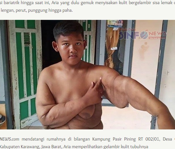 手術前の腕のたるんだ皮膚（画像は『Sinfo News　2019年6月17日付「Aria Permana Butuh Dana Ratusan Juta untuk Operasi Kulit Bergelambir」』のスクリーンショット）