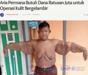 腕の皮膚が邪魔だったというアリヤ君（画像は『Sinfo News　2019年6月17日付「Aria Permana Butuh Dana Ratusan Juta untuk Operasi Kulit Bergelambir」』のスクリーンショット）