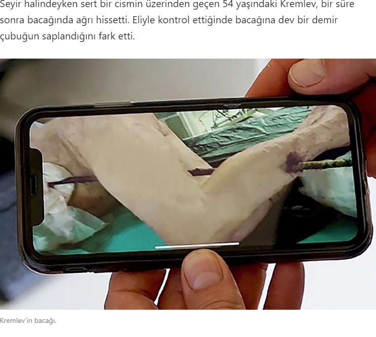 ふくらはぎから太腿に刺さった鉄の棒（画像は『Sözcü Gazetesi　2020年7月21日付「Mucize kurtuluş! Arabadayken saplandı… Doktorlar bile inanamadı」』のスクリーンショット）