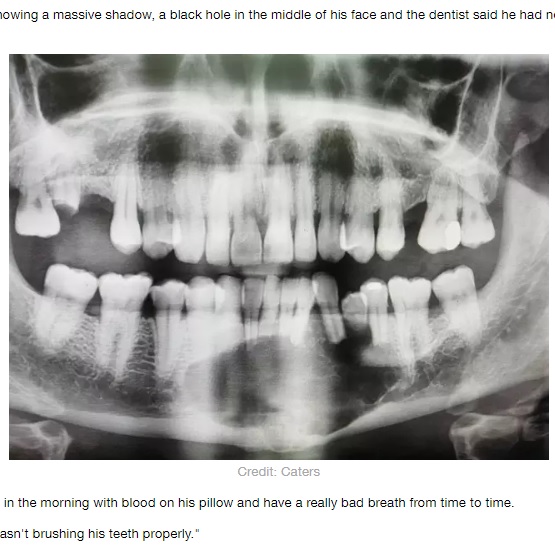 腫瘍の影が映るダレンさんのレントゲン写真（画像は『LADbible　2020年7月13日付「Man Who Hadn’t Been To Dentist For 27 Years Had To Have Jaw Removed After Tumour Discovery」（Credit: Caters）』のスクリーンショット）