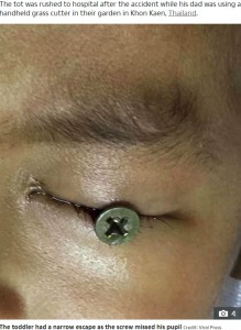 男児の目に刺さったネジ（画像は『The Sun　2020年7月21日付「FREAK ACCIDENT Boy, 3, has eyeball pierced with screw after lawnmower spits out bolt as doctors miraculously save his eyesight」（Credit: Viral Press）』のスクリーンショット）