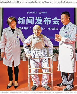 【海外発！Breaking News】背骨が弓なりに曲がり28年　4度の手術で生まれ変わった46歳男性　母の顔を正面から見れるように（中国）