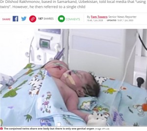 ウズベキスタンで誕生した頭が2つある赤ちゃん（画像は『Daily Star　2020年7月1日付「‘Two-headed’ baby born to baffled doctors and placed in intensive care」（Image: STV.UZ）』のスクリーンショット）
