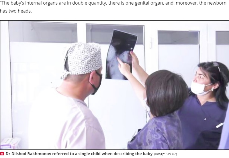 誕生した結合双生児の検査結果を分析する医師ら（画像は『Daily Star　2020年7月1日付「‘Two-headed’ baby born to baffled doctors and placed in intensive care」（Image: STV.UZ）』のスクリーンショット）
