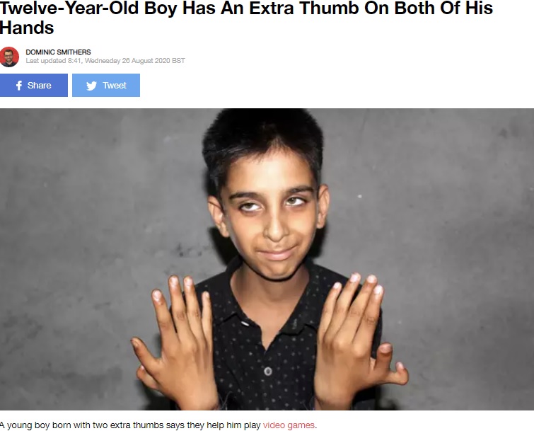 12本の手指を持つ少年（画像は『LADbible　2020年8月26日付「Twelve-Year-Old Boy Has An Extra Thumb On Both Of His Hands」（Credit: SWNS）』のスクリーンショット）