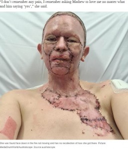 皮膚移植をして4日後のヘイリーさん（画像は『News.com.au　2020年8月20日付「Woman’s face ‘burned off’ in unexplained accident with campfire」（Picture: MediaDrumWorld/Australscope）』のスクリーンショット）