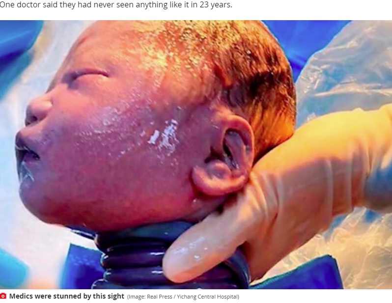 へその緒が6回も巻き付いた男児（画像は『Mirror　2020年8月6日付「Medical miracle as baby born with umbilical cord wrapped six times around neck survives」（Image: Real Press / Yichang Central Hospital）』のスクリーンショット）