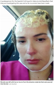接着剤によって頭皮に火傷を負ったマルセラさん（画像は『The Sun　2020年7月30日付「RANDOM ATTACK Woman suffers horror burns after stranger slaps glue-filled hat on her head in brutal doorstep attack」（Credit: Newsflash）』のスクリーンショット）