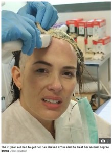 マルセラさんは結局、剃髪する羽目に（画像は『The Sun　2020年7月30日付「RANDOM ATTACK Woman suffers horror burns after stranger slaps glue-filled hat on her head in brutal doorstep attack」（Credit: Newsflash）』のスクリーンショット）