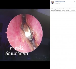 電池のせいで鼻腔内が火傷した状態に（画像は『Arak Wongworachat　2020年8月27日付Facebook「＃เด็ก3ขวบเอาแบตเตอรี่นาฬิกาใช้แล้วใส่จมูก」』のスクリーンショット）
