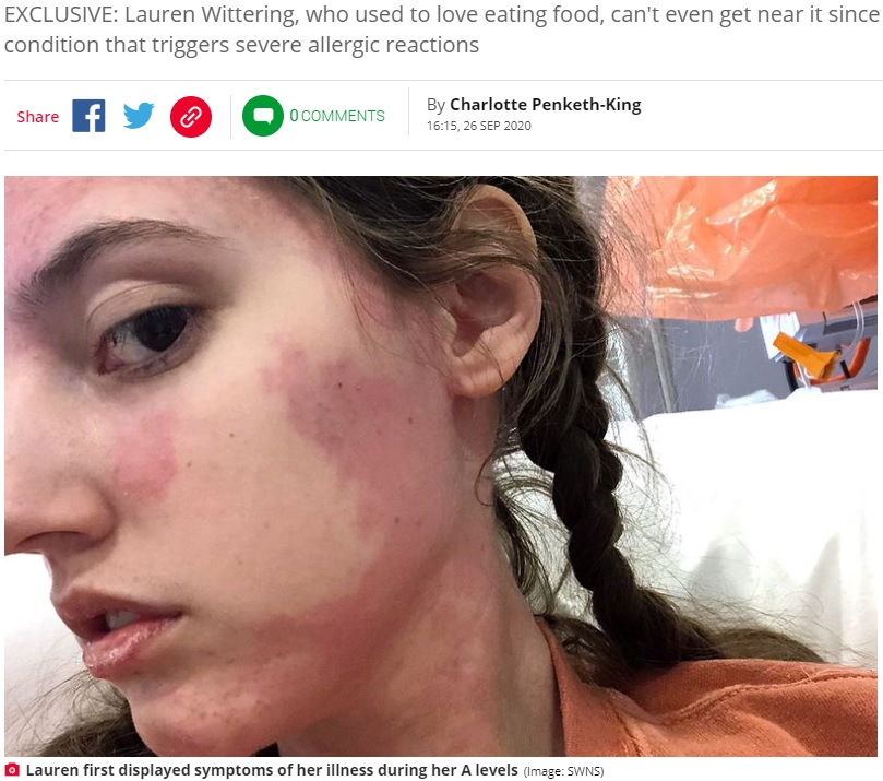 顔や首にも蕁麻疹が現れる20歳の女性（画像は『Daily Star　2020年9月26日付「Woman, 20, fed through heart after deadly illness makes her allergic to all food」（Image: SWNS）』のスクリーンショット）