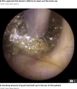 長年にわたり蓄積された耳垢（画像は『The Sun　2020年9月9日付「EAR TODAY GONE TOMORROW Stomach-churning video shows audiologist removing 16 YEARS worth of ear wax from patient」（Credit: Caters News Agency）』のスクリーンショット）