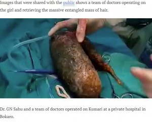 摘出された毛髪の塊（画像は『AllIndiaRoundup　2020年9月5日付「Doctors Remove Massive 7 Kilogram Hairball From Teen’s Stomach After She Chewed Hair For Years」』のスクリーンショット）