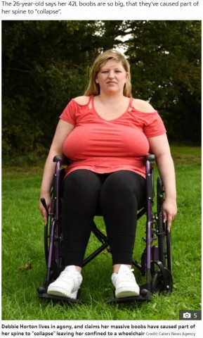 【海外発！Breaking News】Rカップの重みで背骨が湾曲、車椅子生活になってしまった女性（英）